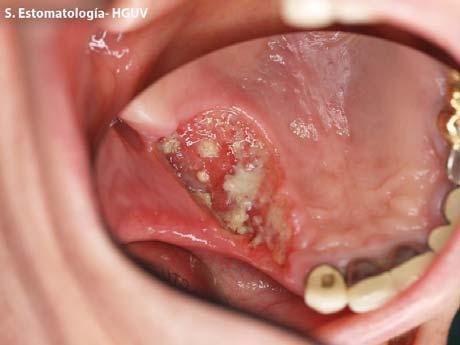 agudo e intenso en toda la cavidad oral que le impide la correcta masticación y deglución acompañado de unas lesiones en