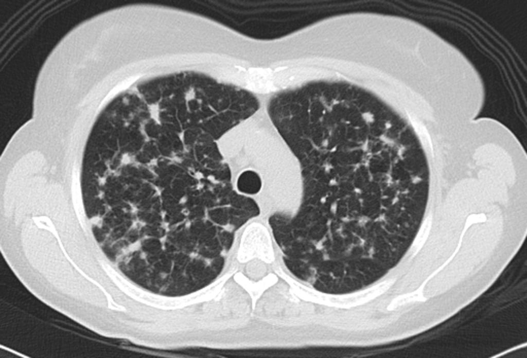 disminución del número y tamaño de los nódulos pulmonares bilaterales. (Figuras 11 y 12) Fig. 8: Paciente mujer de 47 años fumadora con clínica de 3-4 semanas de tos seca, disnea y fiebre.