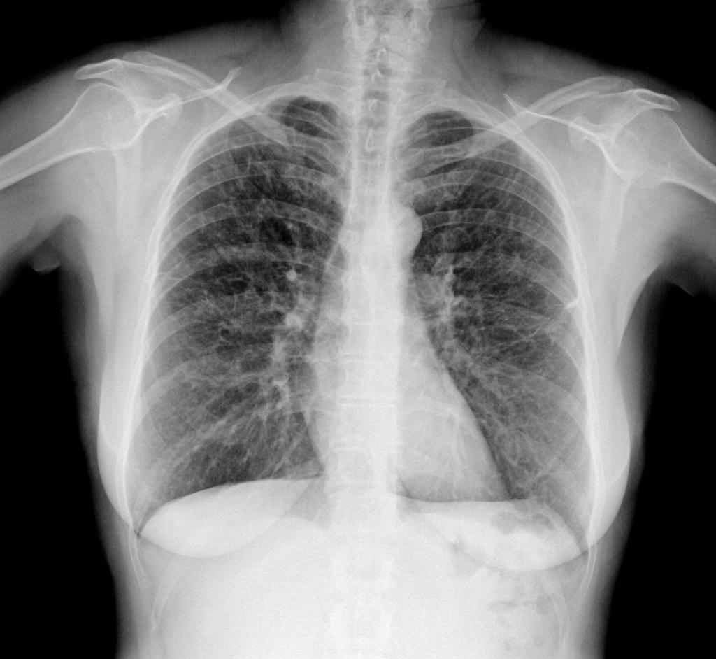 Fig. 11: Paciente mujer de 47 años fumadora con clínica de 3-4 semanas de tos seca, disnea y fiebre. (Figuras 6-10) Radiografía de tórax y TC: Se detecta hiperinsuflación pulmonar bilateral.