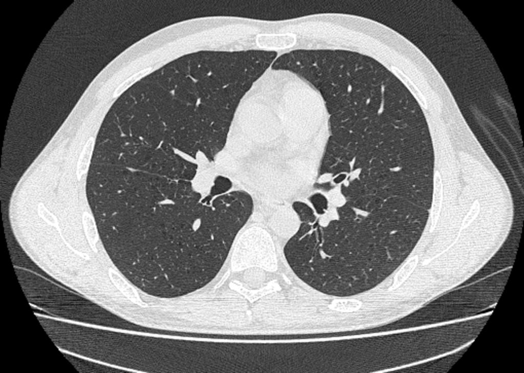 Fig. 14: Varón de 38 años con HCL en tratamiento con quimioterapia (Figuras 13-15) En la TCAR realizada se observan en el parénquima pulmonar pequeños quistes