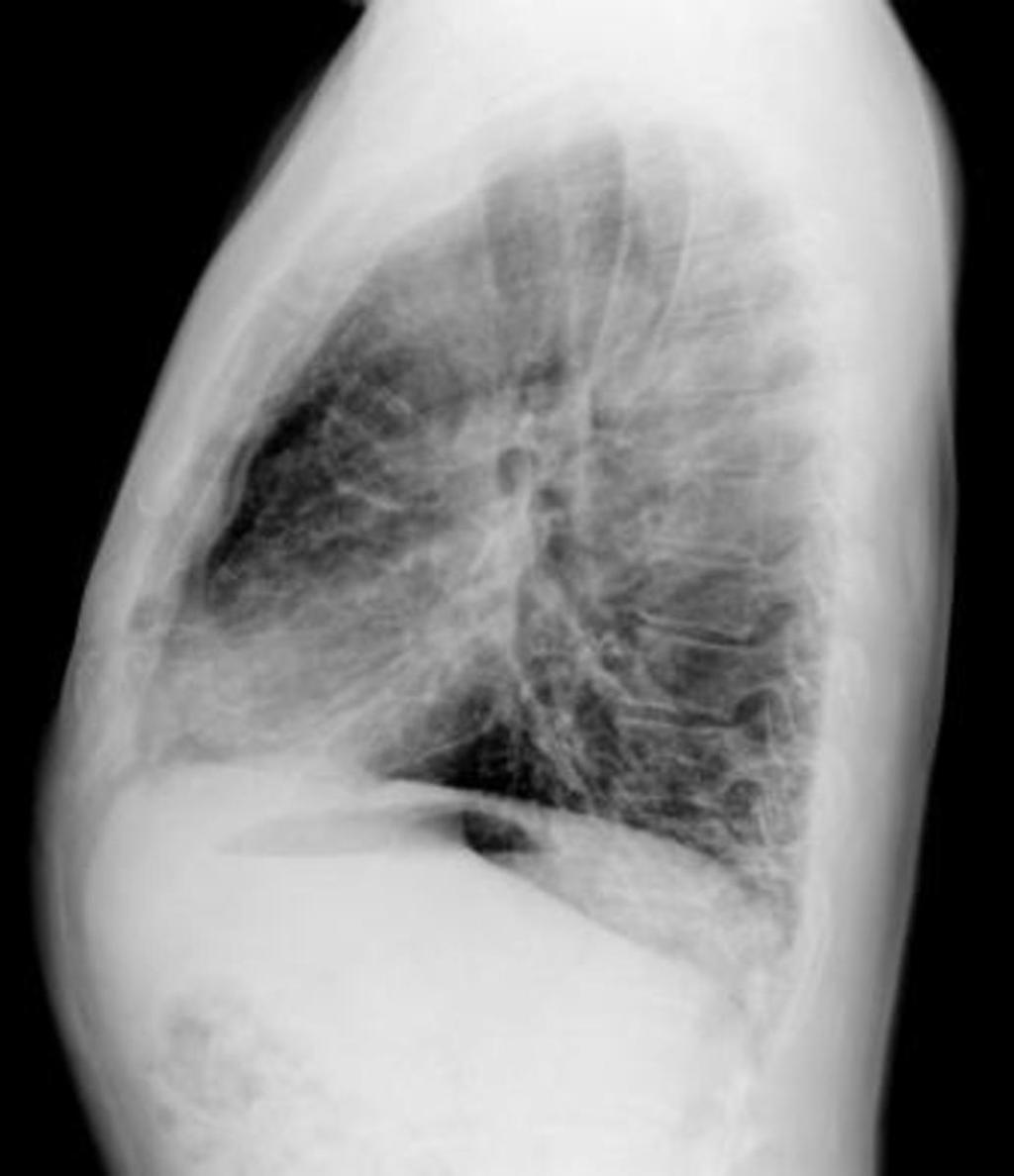 Fig. 17: Paciente de 59 años de edad diagnosticado de HCL con disnea.
