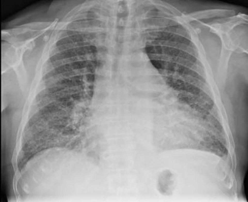 Fig. 20: Paciente de 64 años con síntomas respiratorios en relación en relación con antecedentes de Histiocitosis de células de Langerhans.