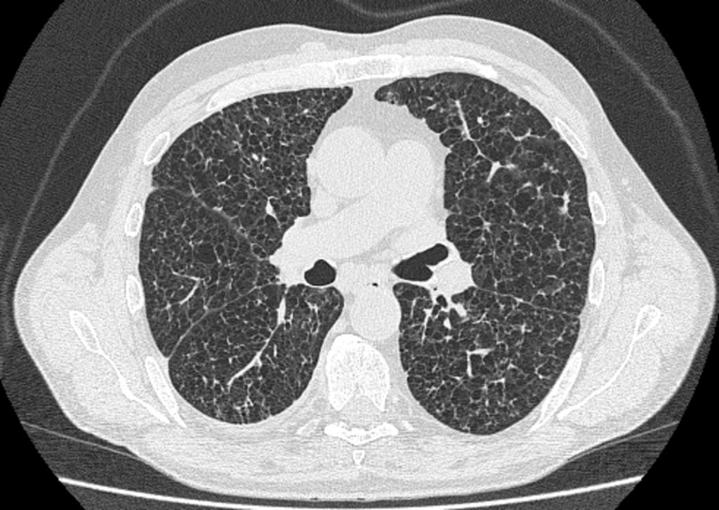 Fig. 28: Paciente mujer de 69 años con síntomas respiratorios ya diagnosticada en otro centro de Histiocitosis X que acude a nuestro hospital para nueva valoración por el servicio de Neumologia.