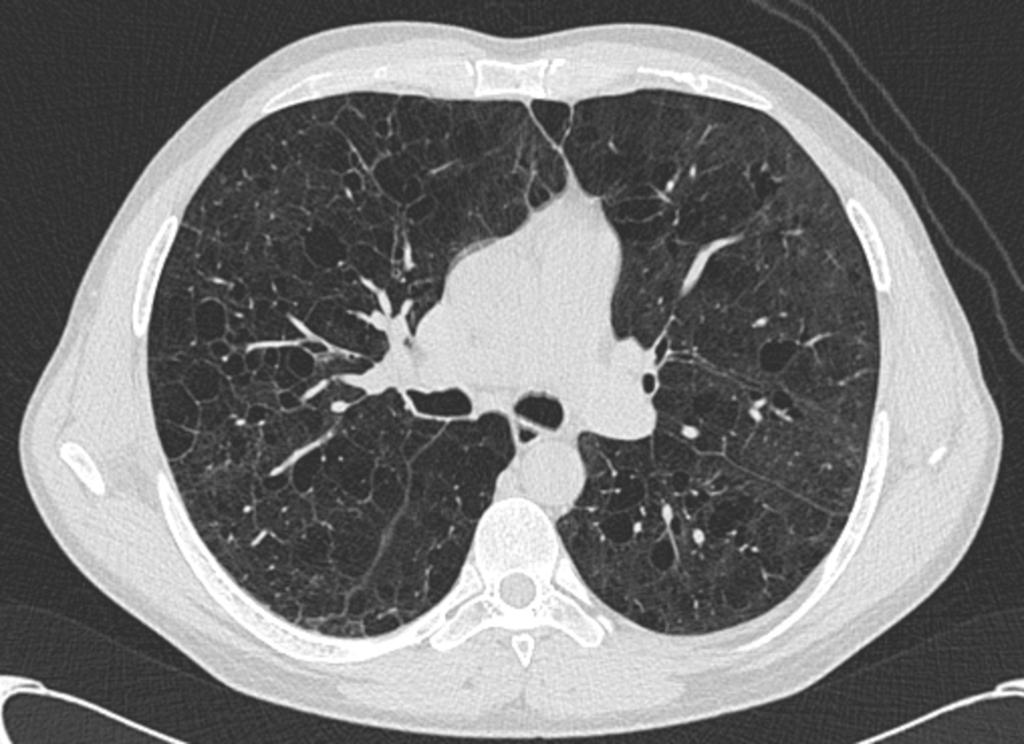 Fig. 4: Paciente varón de 35 años con clínica de disnea de lenta evolución. (figuras 1-5). Radiografía de tórax frontal y lateral.