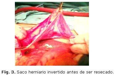 esternocostal derecha (Fig. 2), sin afectación vascular, y un vólvulo gástrico órgano axial, por la rotación anterior y superior del antro, fueron los hallazgos quirúrgicos más relevantes.