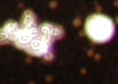 Criptococosis La criptococosis en una micosis sistémica que comparte características con el grupo de