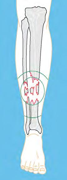 Zona de lesión (Marvin Tile 1984) La zona de lesión de las partes blandas es más amplia que el foco