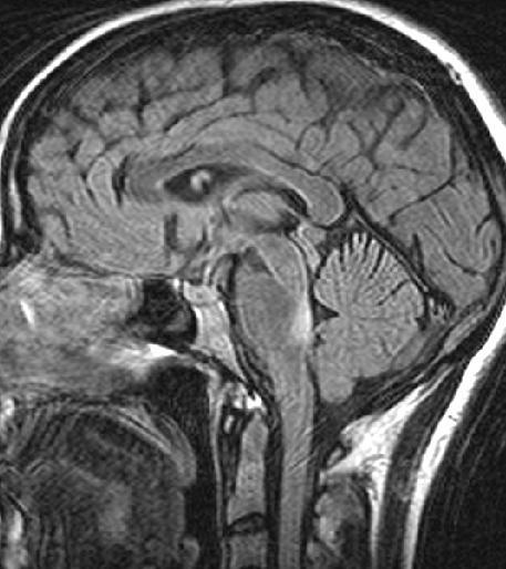 Afección del tronco encefálico La EM, con frecuencia afecta al tronco encefálico