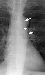 5. Ventana Aorto-pulmonar: Morfología cóncava o