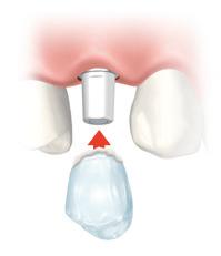 Si el implante gira al apretar el pilar, evalúe de nuevo la estabilidad primaria del implante y considere una técnica sumergida.