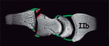 Fotografía clínica dorsal y palmar que muestra la divergencia del segundo y tercer dedos, así como