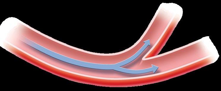cerebrovascular. Esta figura muestra aterosclerosis o endurecimiento de las arterias.