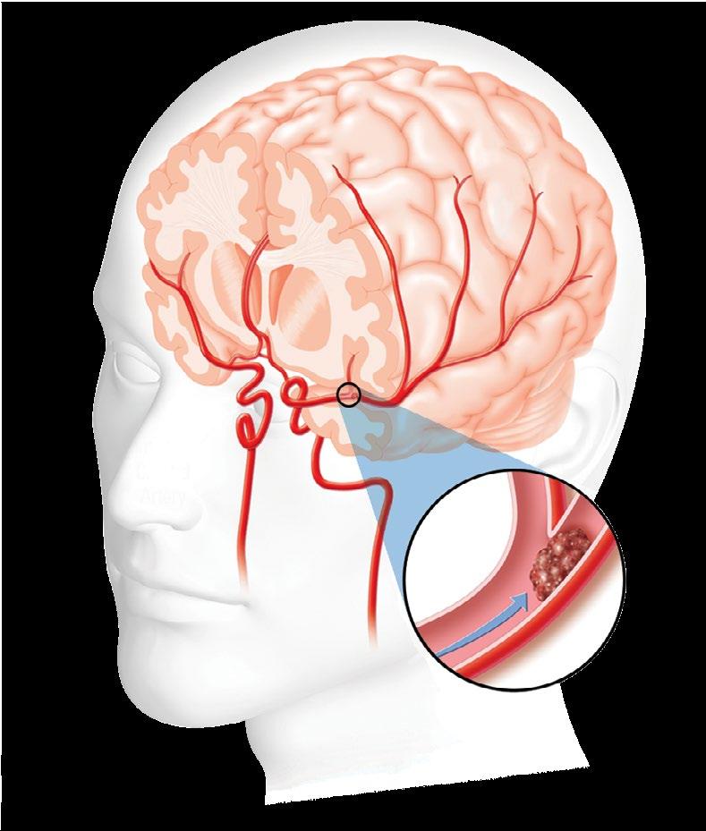 Ataque isquémico transitorio (AIT) Arteria cerebral anterior Arteria cerebral media Arteria carótida interna Obstrucción Si una arteria dentro del cerebro o que va al cerebro es obstruida por un