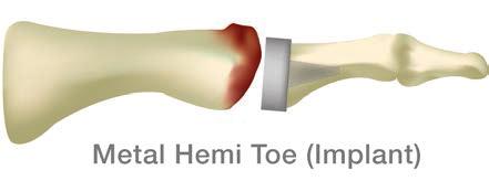 Por qué se coloca la prótesis HemiCAP en el lado del metatarso?