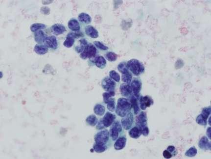 Tumors malignes de cèl lula petita