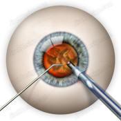 Figura 2.6 Incisión, capsulorrexis y retirada del cortex. Imagen procedente de ocularis.