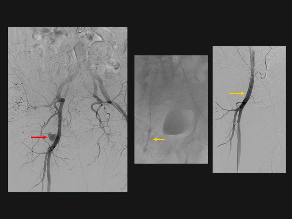 Fig. 10: Angiografía realizada a través de arteria femoral izquierda para tratamiento con endoprótesis recubierta (flechas