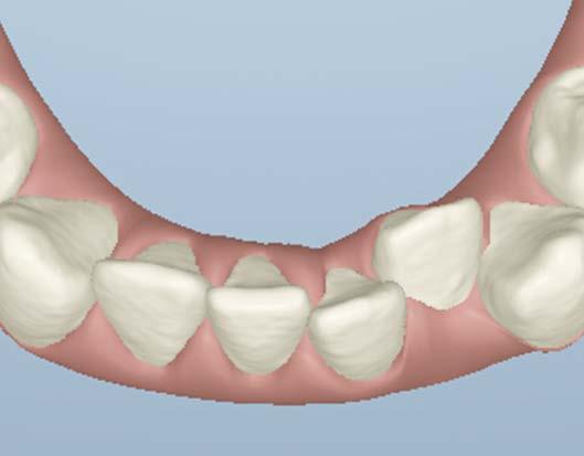 Es más predecible tratar apiñamientos con Invisalign Si... los dientes anteriores se encuentran retroclinados o verticales.