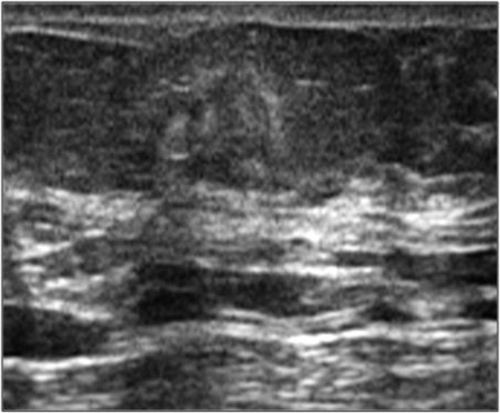 Fig. 2: Lesión ovalada de ecoestructura ecogénica, bien definida, horizontal a plano superficial en paciente con antecedente traumático: