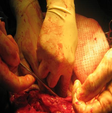 B: Cierre parcial del peritoneo del saco herniario, posterior a la lisis de adherencias intrasaculares. Fig. 2 Detalles del procedimiento quirúrgico.
