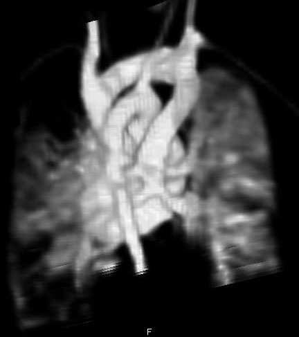 a la aurícula por el margen izdo. de la aorta abdominal.