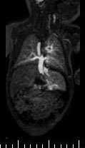 * ^ A B Paciente de 8 días de vida, diagnosticada por ecocardiografía de DVPAT infracardiaco (tipo III), asociado a asplenia, hígado en torta, cámara