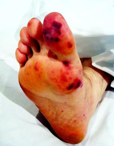 Figura 1. Lesiones cutáneas sugestivas de lesiones de Janeway Foto tomada de paciente del HUMV Manifestaciones secundarias a fenómenos embolicos.