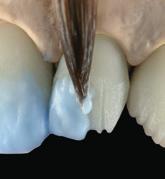 de dentina transparente (p. ej., TD-A1). 4.