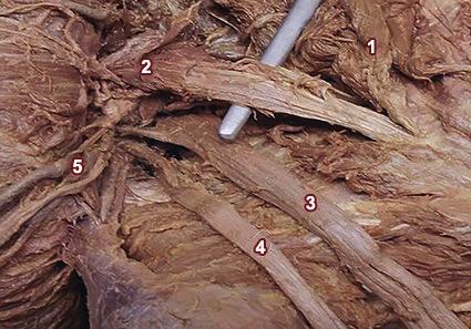 En este último se visualizó un fascículo superior y otro fascículo inferior, con el ramo peróneo ubicado entre ambos y el ramo tibial por debajo de dicha división muscular. (Fig.