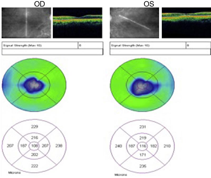 Nótese la ausencia de agujero macular en ambos ojos y la presencia de retinopatía dispuesta en anillo con puntos blanquecinos alrededor del mismo.