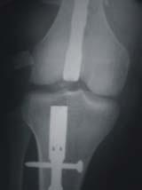 MG Figura 6. Clavo introducido al fémur en forma insuficiente, puede dañar la rótula durante la flexión. Ortho-tips Vol. 2 No. 1 2006 canal sustraídode-m.e.d.i.g.r.a.p.h.i.c medular del fémur con el distal a la fractura.