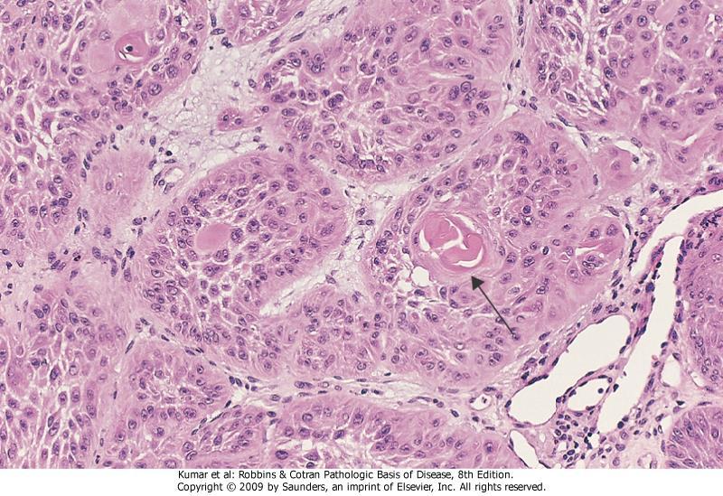 Well-differentiated squamous cell carcinoma of the skin.