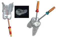 Con un reducido volumen 3D de 5 cm x 5,5 cm, las unidades Orthophos están provistas de un campo de visión adecuado para cada caso de endodoncia.
