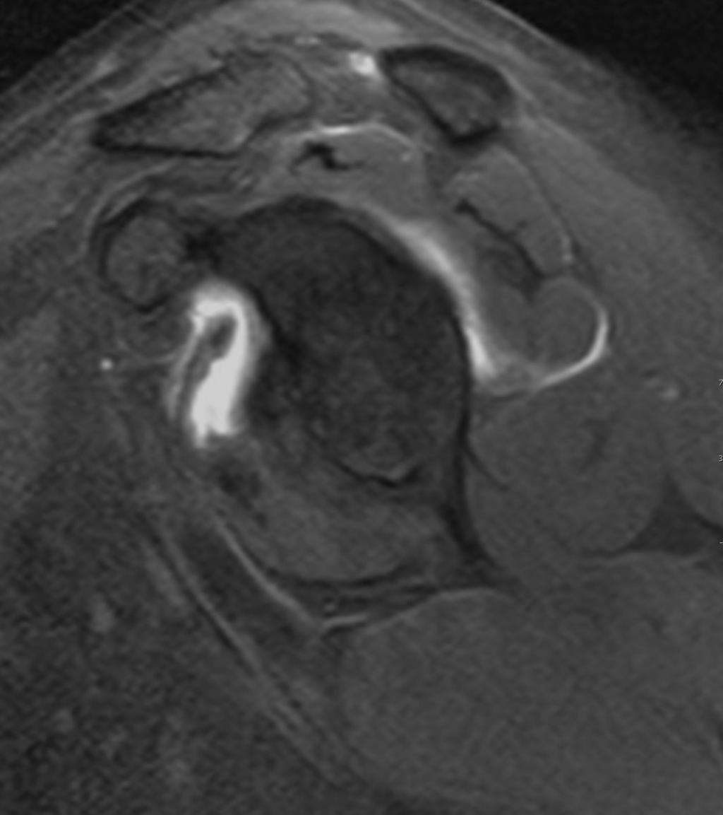 Fig. 3: Artro-RM de hombro, corte coronal.