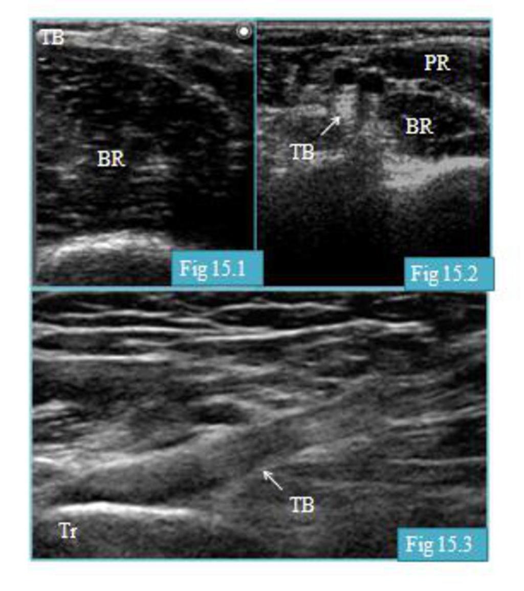 Fig. 15: Músculo braquial Hospital de