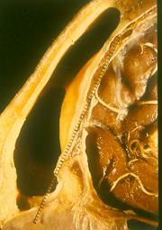 Pared posterior: pterigoides, fosa infratemporal, seno esfenoidal,