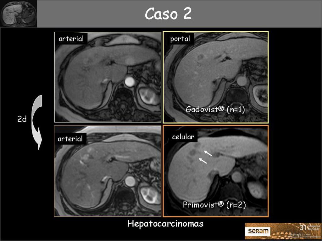 Fig. 14: Mujer de 82 años con cirrosis hepática por VHC con un nódulo de 14mm en el segmento IV con comportamiento característico de hepatocarcinoma.