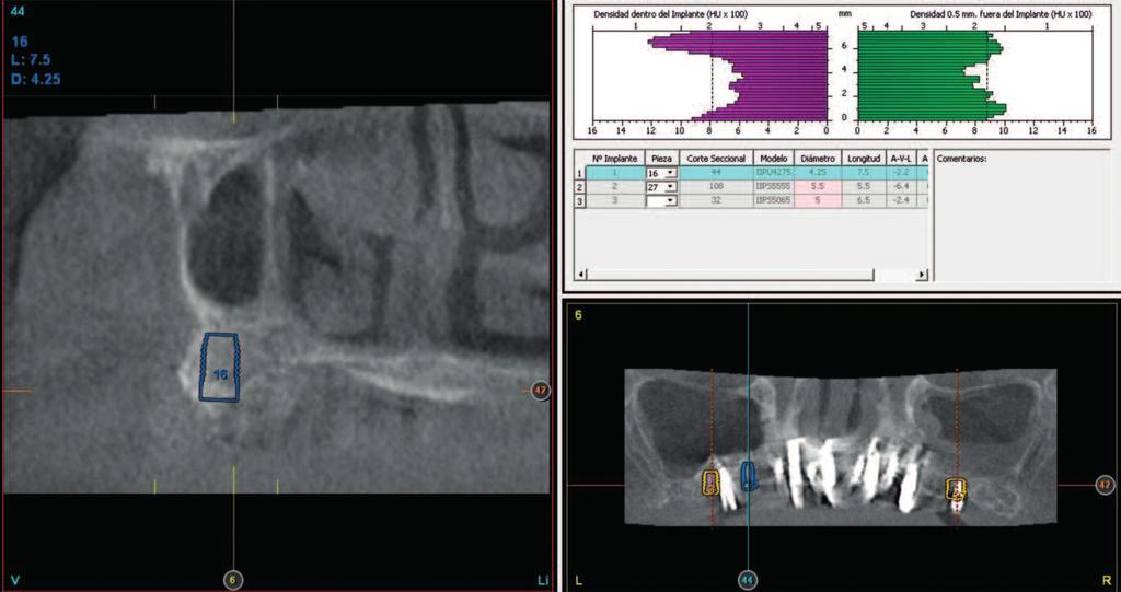 Figs. 7-9. Imágenes de planificación del Cone-Beam, tratadas con el software diagnóstico BTI-Scan III.
