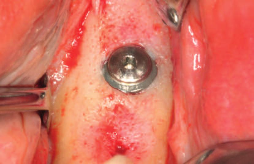 segunda fase de los implantes distales superiores, que ya llevan seis meses insertados, se
