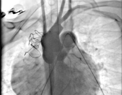 Figura 1 Prueba de compresión coronaria en proyección perfil izquierdo: balón insuflado en la VSVD y angiografía aórtica concomitante mostrando flujo coronario adecuado.