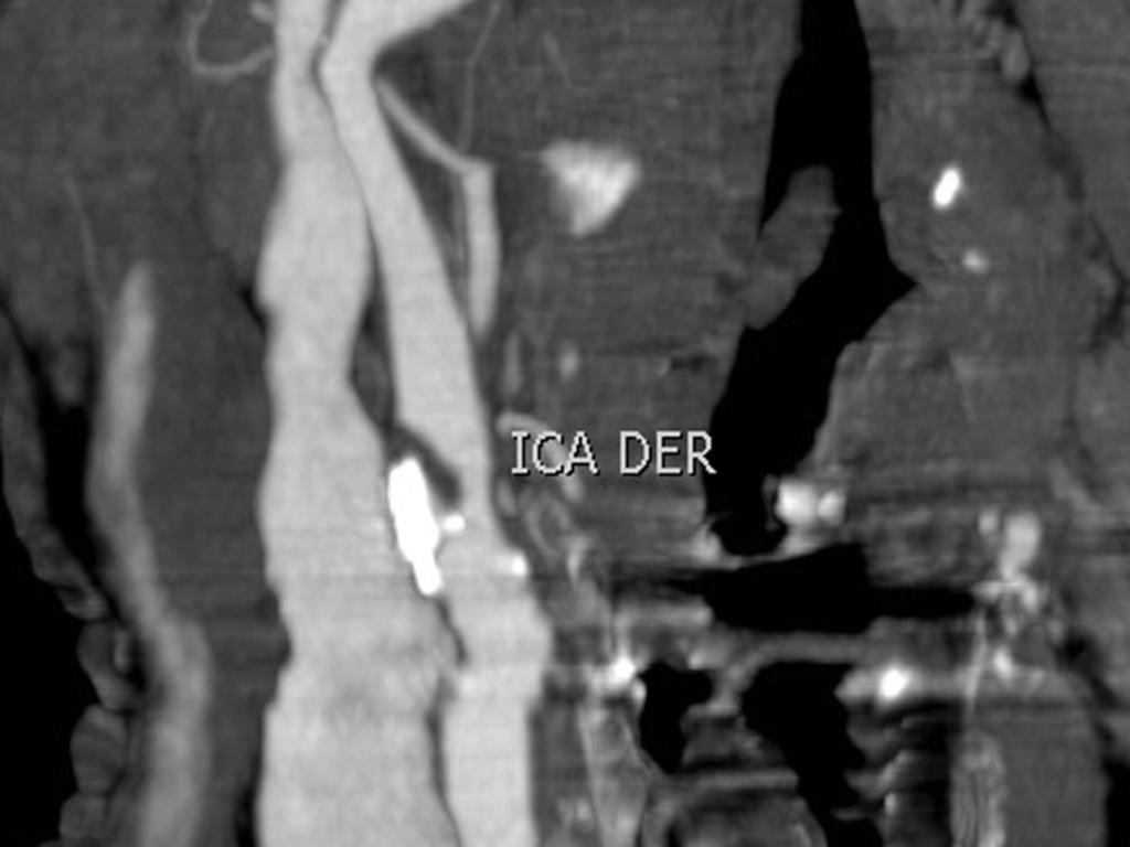 Fig. 9: La imagen MIP del angiotc muestra una estenosis del 60-65 % en la arteria carótida interna derecha. 4- ESTENOSIS CRÍTICA VERSUS OCLUSIÓN COMPLETA.