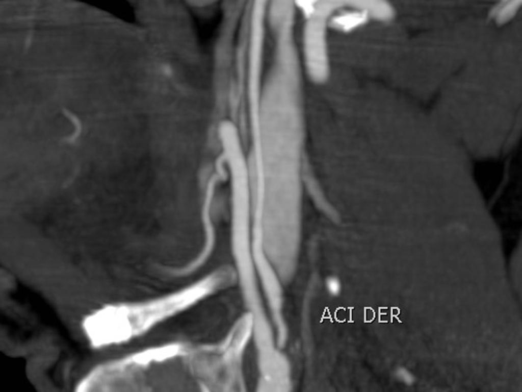 Fig. 12: AngioTC (imagen MIP) que muestra la estenosis y una disminución de calibre de la arteria carótida interna distal (slim sign) 5- ESTENOSIS SEVERA CONTRALATERAL U OCLUSIÓN DE LA ARTERIA