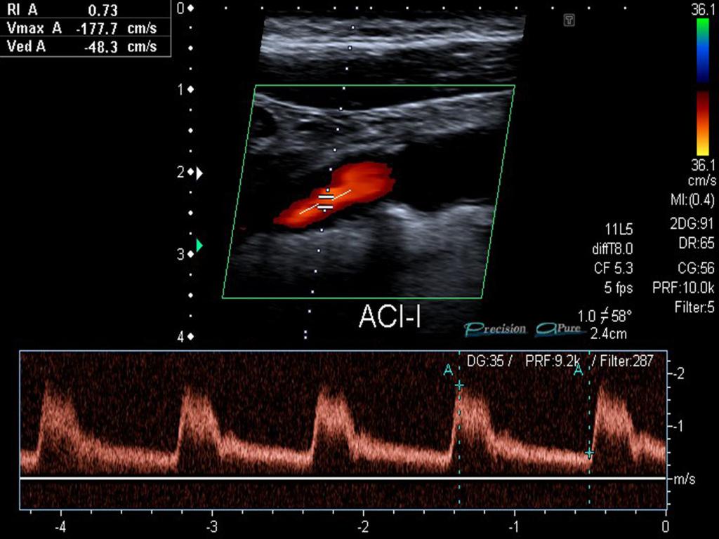 Fig. 15: El espectro Doppler de la arteria carótida interna izquierda muestra un aumento de las velocidades, con pico sistólico de velocidad en torno a 180