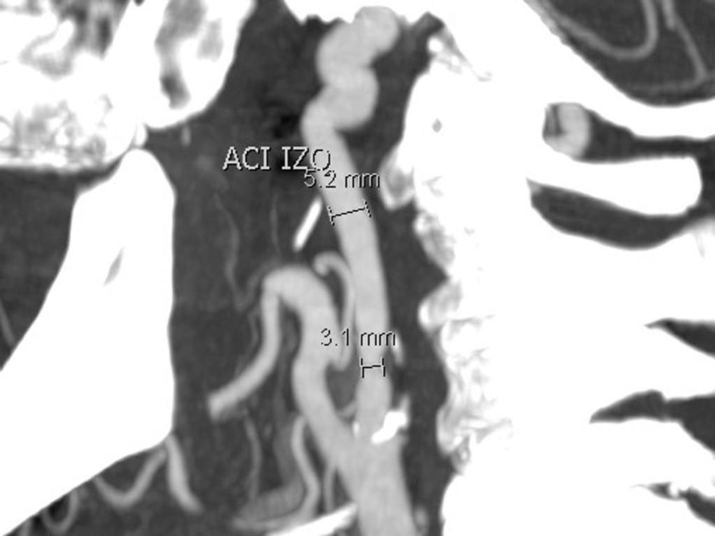 Fig. 16: AngioTC (imagen MIP): La estenosis de la arteria carótida interna izquierda es