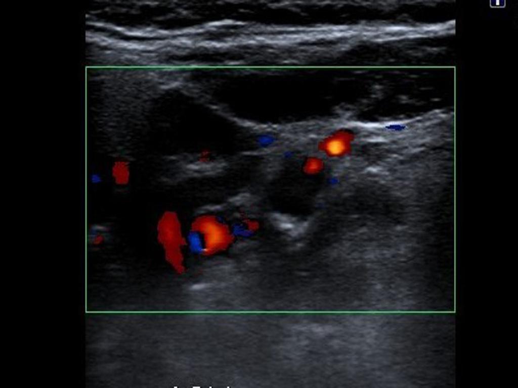 Fig. 22: Ecografía Doppler color (imagen axial): se observa obstrucción de la arteria carótida interna izquierda y pequeña imagen de flujo adyacente a la pared.