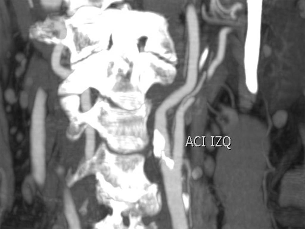 Fig. 3: Lesión en tandem en paciente de 67 años con episodio presincopal. AngioTC muestra una importante estenosis en el segmento proximal de la arteria carótida interna izquierda, en torno al 70%.