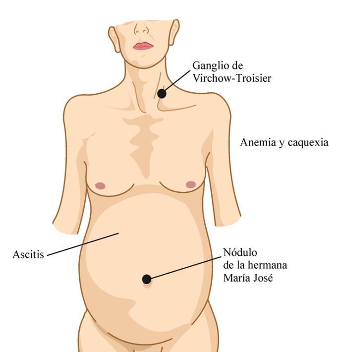 Trastornos Digestivos: ASCITIS 1. Estado del tumor y del paciente: avanzado y deteriorado 2.