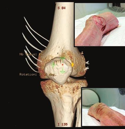 Técnicas de reconstrucción del ángulo posterolateral de la rodilla [ ] mento de Ciencias Morfológicas de la Universidad Autónoma de Barcelona. Tenían una media de edad de 74,7 años.