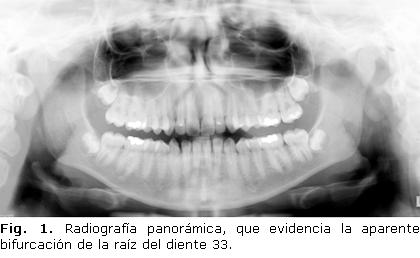 El objetivo del artículo es presentar el caso de un canino mandibular con dos raíces con sus respectivos canales radiculares. PRESENTACIÓN DEL CASO Paciente femenina de 21 años.
