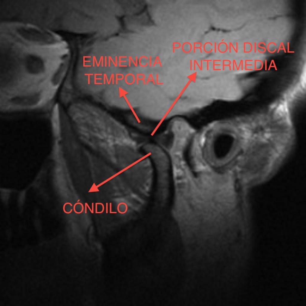 1. 2. Desplazamiento anterior del cóndilo mandibular hasta situarse inmediatamente por debajo de la eminencia temporal.